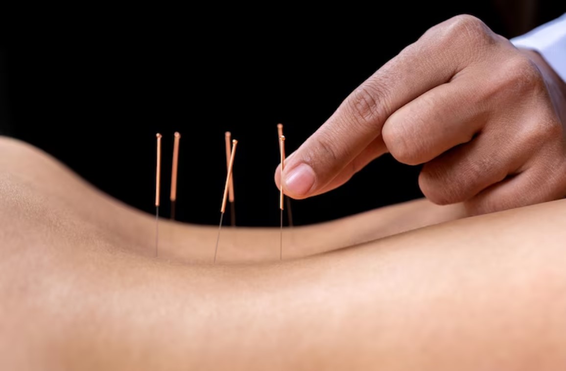 Acupuncture Disadvantages: Myth vs. Reality in Healthcare
