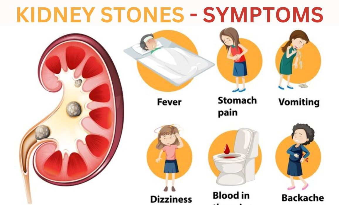 Kidney Stones Causes, Symptoms, and Homeopathy Treatment