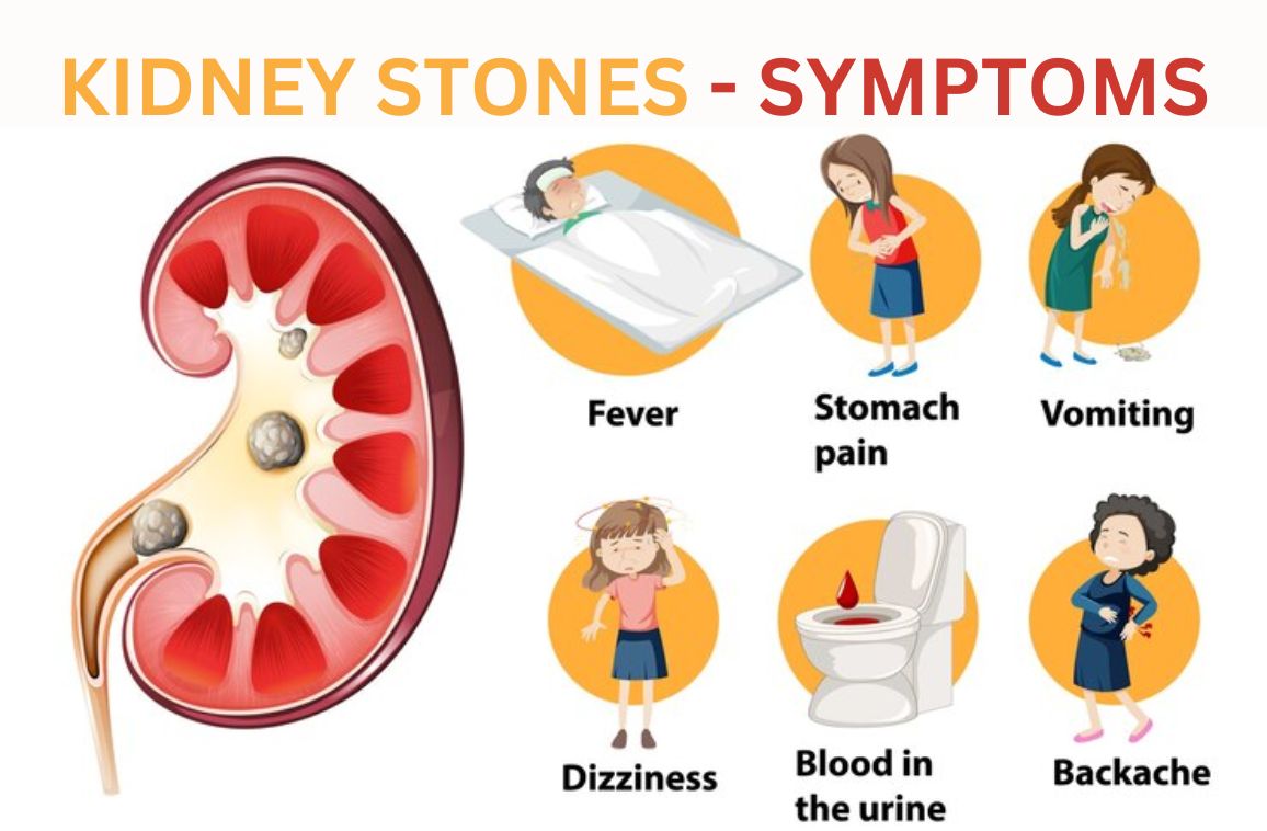 Kidney Stones Causes, Symptoms, and Homeopathy Treatment