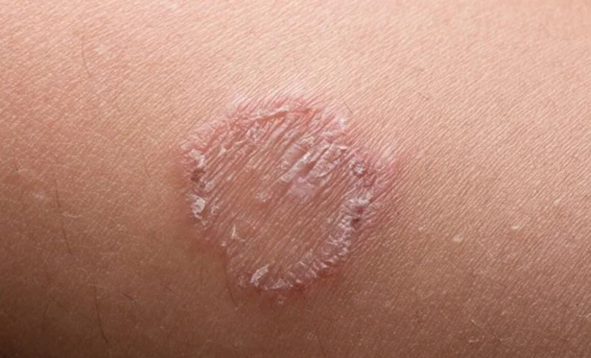 Top causes of ringworm and how to prevent it?