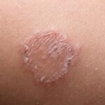 Top causes of ringworm and how to prevent it?