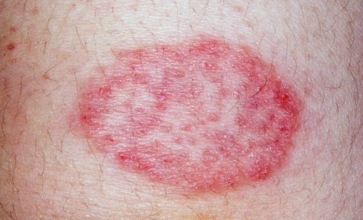 10 Common Skin Rashes and Spots on Skin