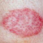 10 Common Skin Rashes and Spots on Skin