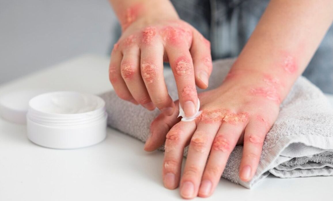 Homeopathy for Skin Allergies: Safe  & Natural Relief