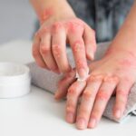 Homeopathy for Skin Allergies: Safe  & Natural Relief